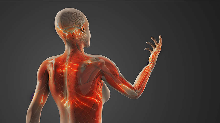 Artist Rendering of Woman with CRPS